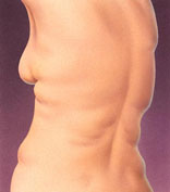 Liposuction surgical procedure