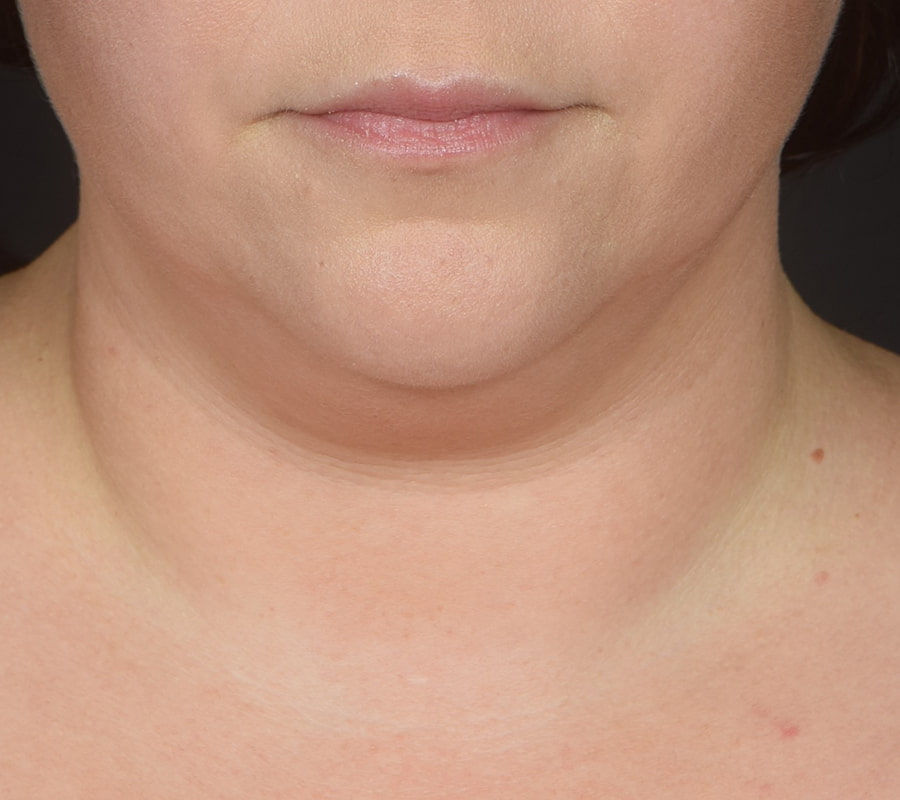 Renuvion Skin Tightening Before & After Image