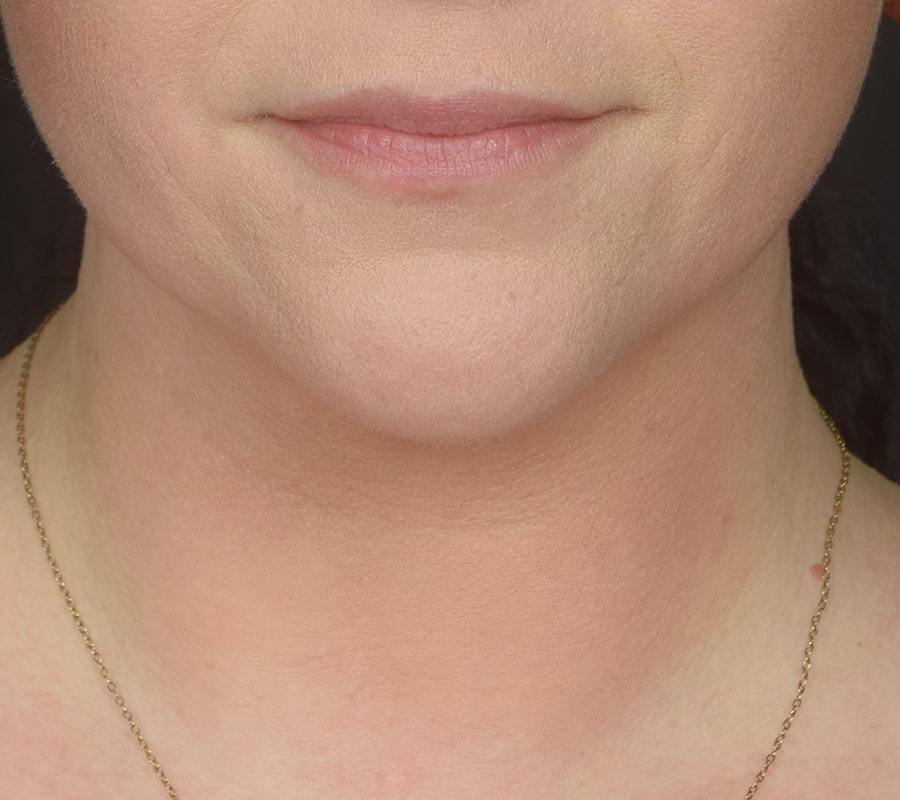 Renuvion Skin Tightening Before & After Image