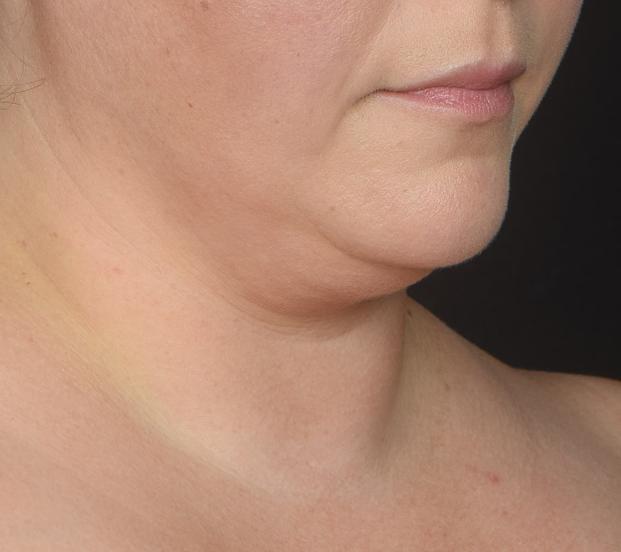 Renuvion Skin Tightening Before & After Image