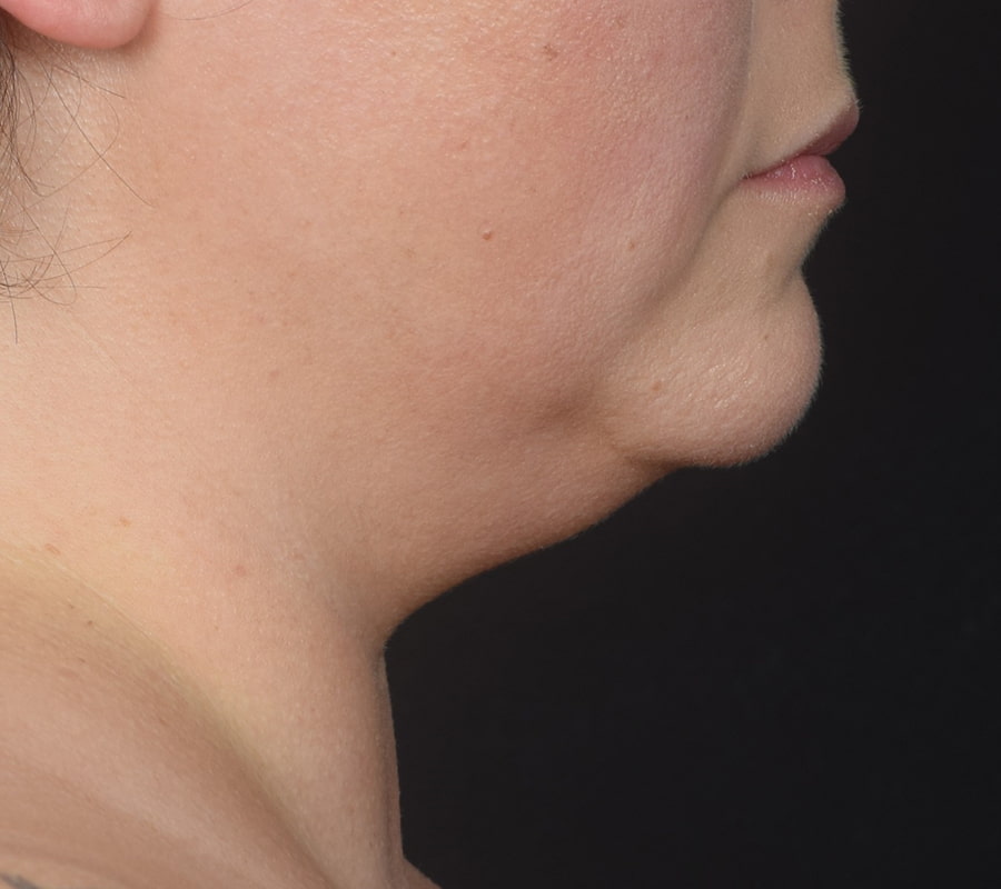 Renuvion Skin Tightening Before & After Image