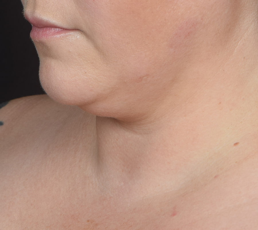 Renuvion Skin Tightening Before & After Image