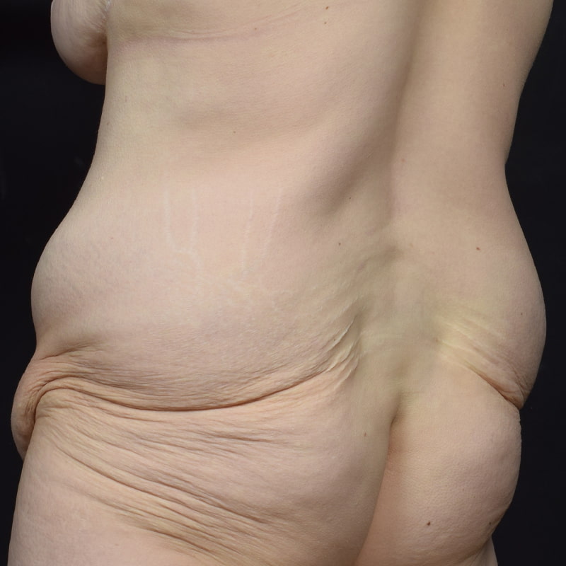 Tummy Tuck Before & After Image