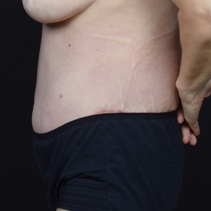 Tummy Tuck Before & After Image