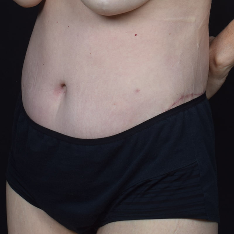 Tummy Tuck Before & After Image