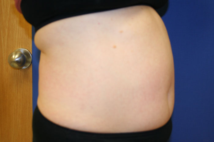 Tummy Tuck Before & After Image