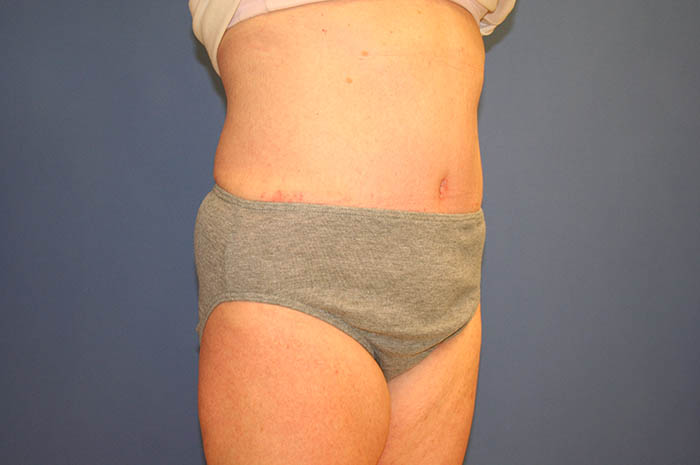 Tummy Tuck Before & After Image