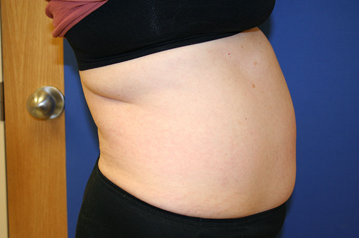 Tummy Tuck Before & After Image