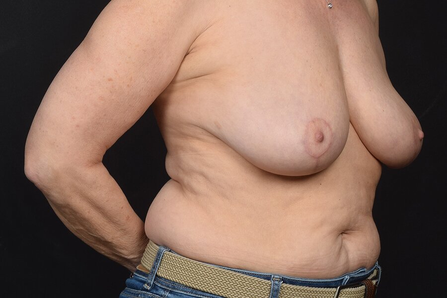 Breast Implant Removal With Lift Before & After Image