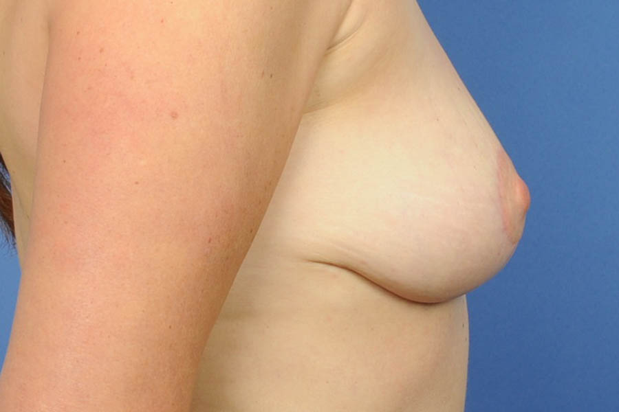 Breast Implant Removal Before & After Image