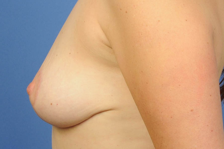 Breast Implant Removal Before & After Image