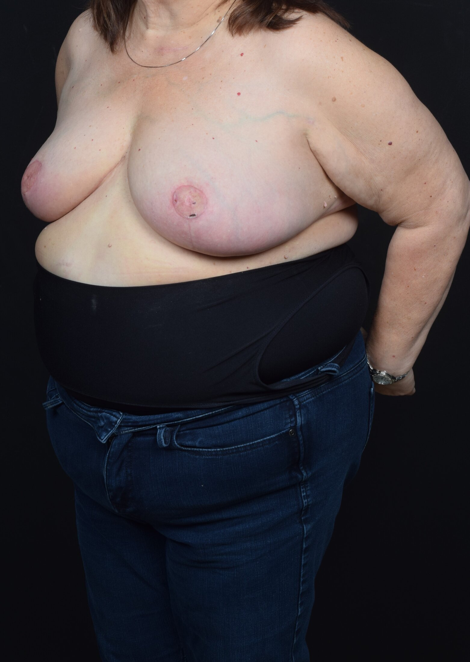 Breast Reconstruction Before & After Image