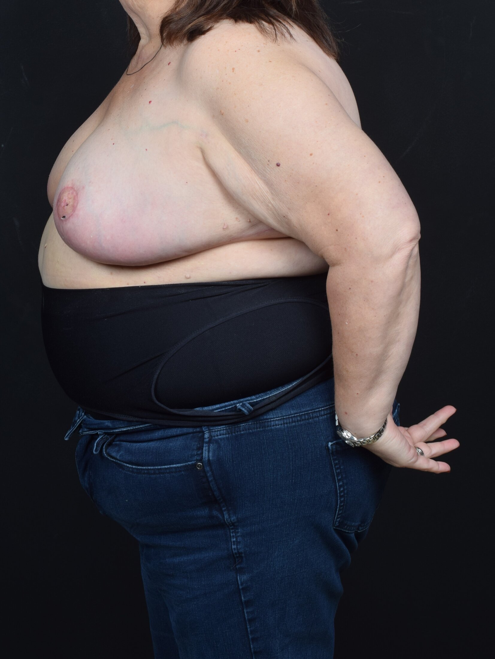 Breast Reconstruction Before & After Image