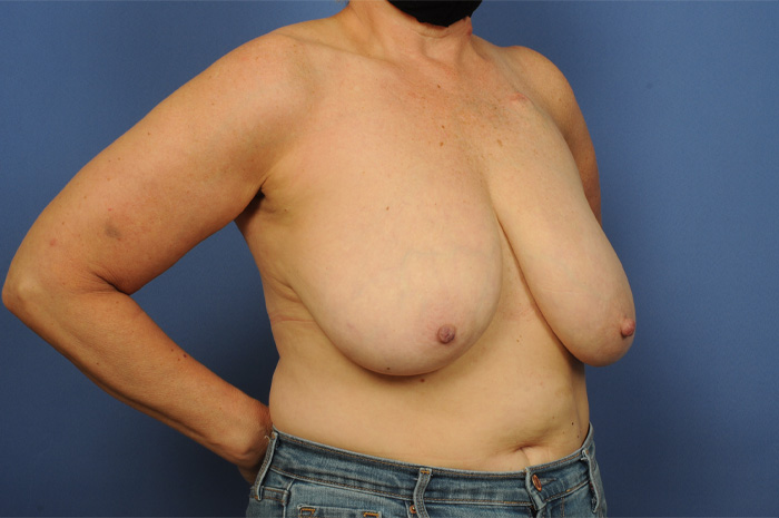 Breast Reconstruction Before & After Image