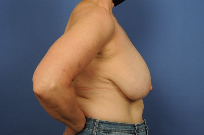 Breast Reconstruction Before & After Image