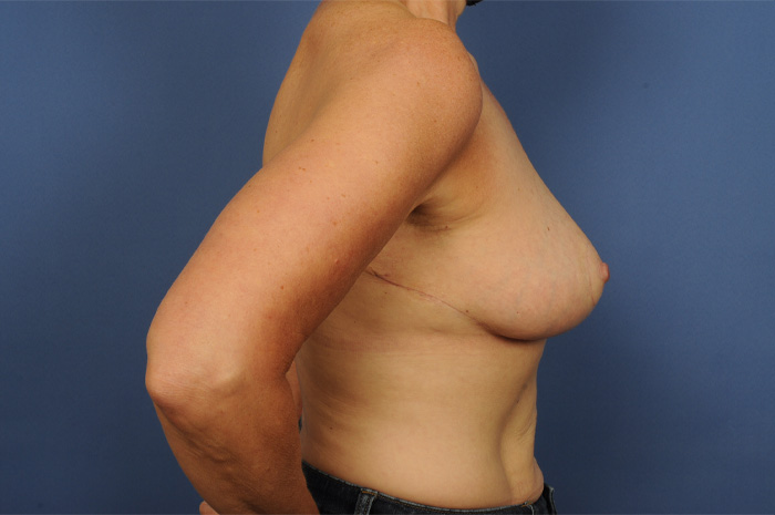 Breast Reconstruction Before & After Image