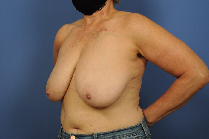 Breast Reconstruction Before & After Image