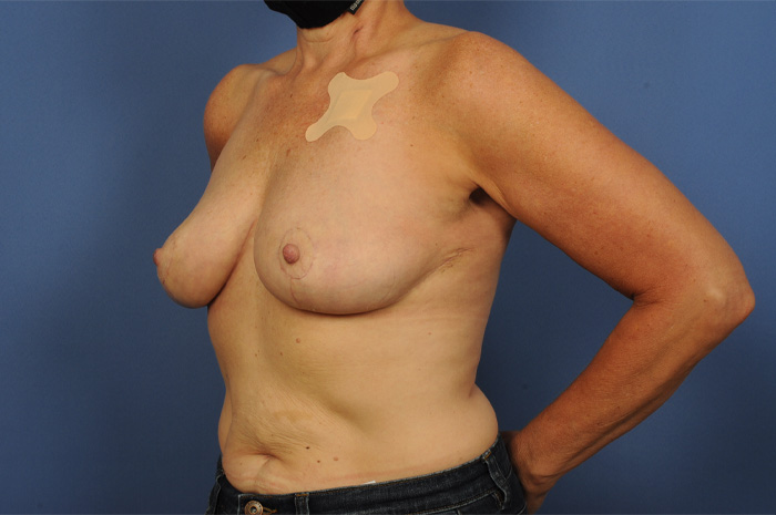 Breast Reconstruction Before & After Image