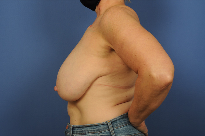 Breast Reconstruction Before & After Image