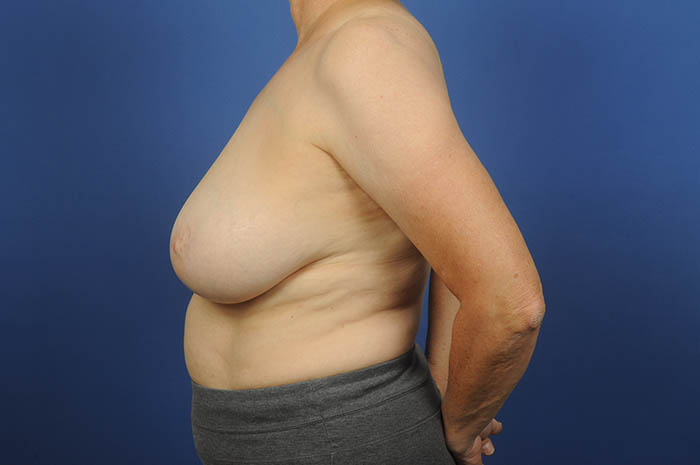 Breast Reduction Before & After Image