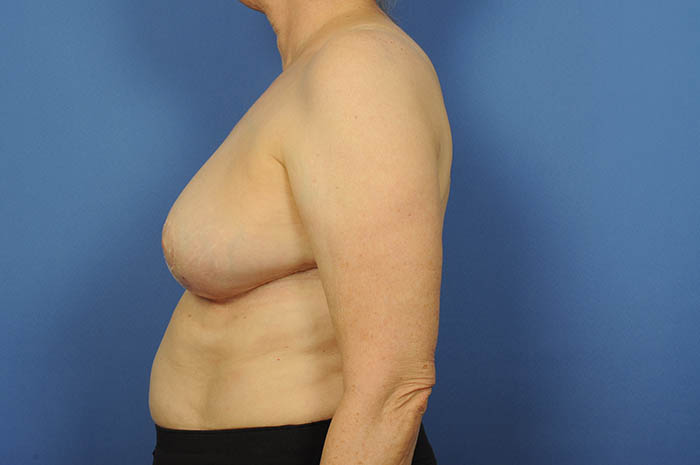 Breast Reduction Before & After Image