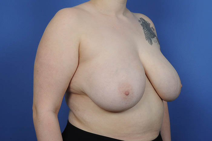 Breast Reduction Before & After Image