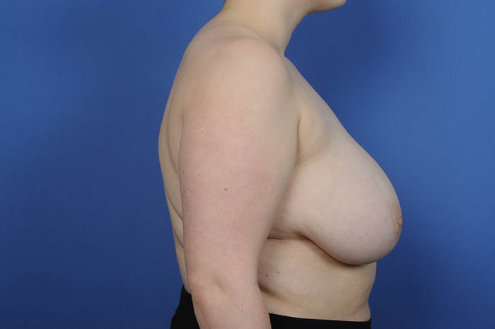 Breast Reduction Before & After Image