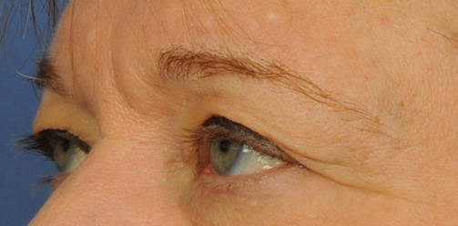 Eyelid Surgery Before & After Image