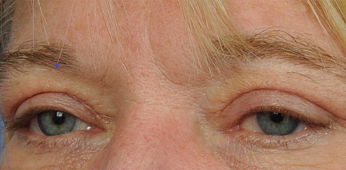 Eyelid Surgery Before & After Image