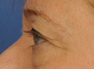 Eyelid Surgery Before & After Image