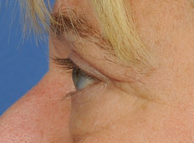 Eyelid Surgery Before & After Image