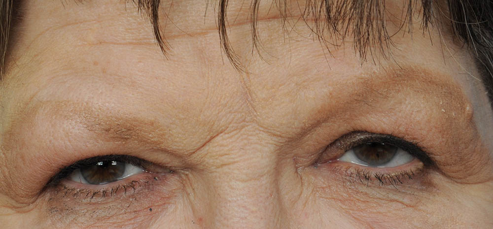 Eyelid Surgery Before & After Image