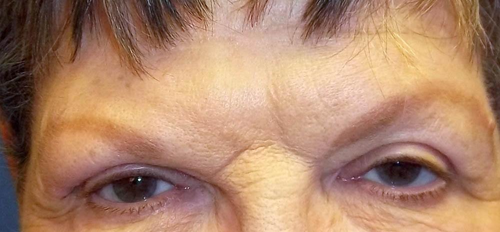 Eyelid Surgery Before & After Image