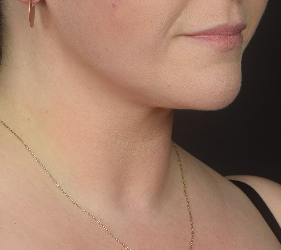 Neck Liposuction Before & After Image