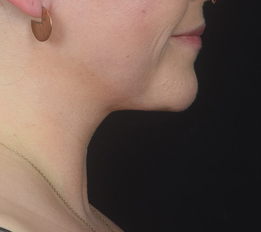 Neck Liposuction Before & After Image