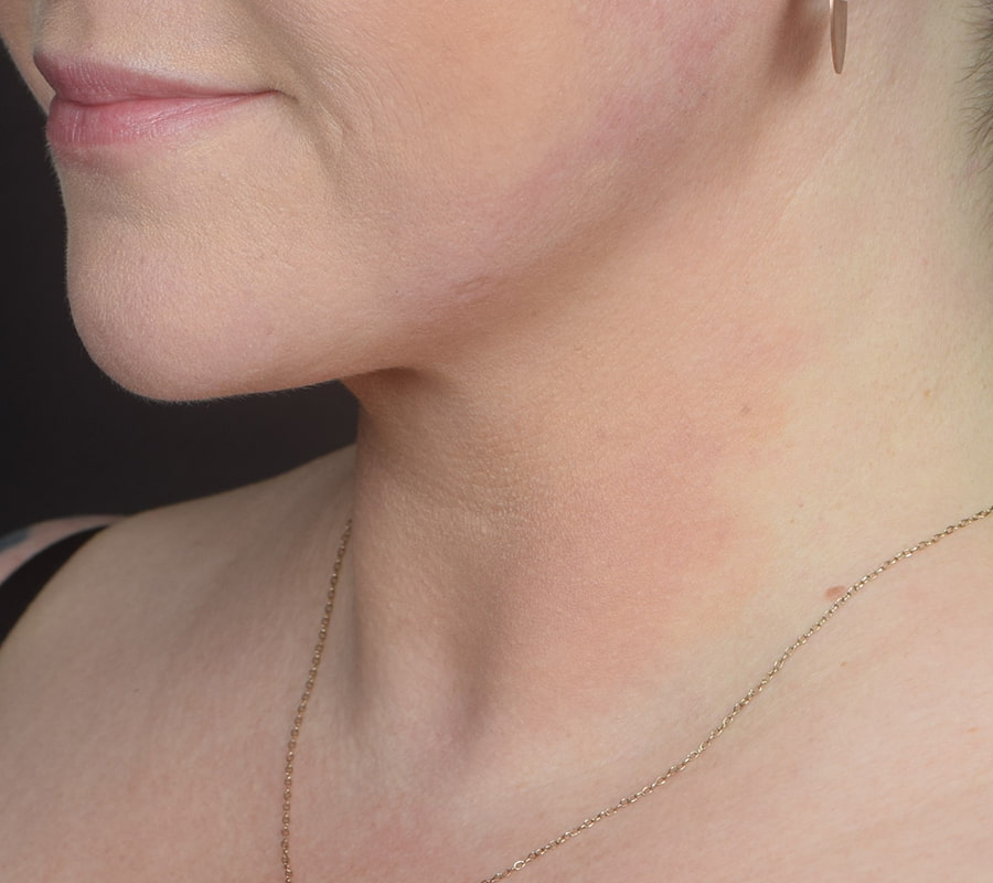 Neck Liposuction Before & After Image