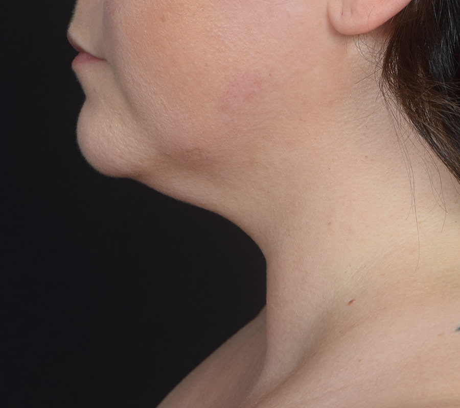 Neck Liposuction Before & After Image