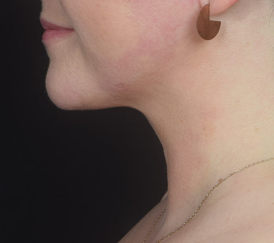 Neck Liposuction Before & After Image